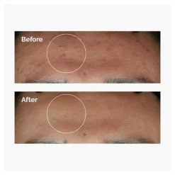 Niacinamide 10% + Zinc 1%